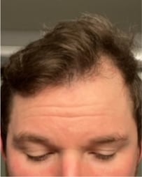 Frontal view of brunette man's hairline, before Curology use.