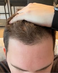 Curly-haired man's hairline, after 1 month of Curology use.